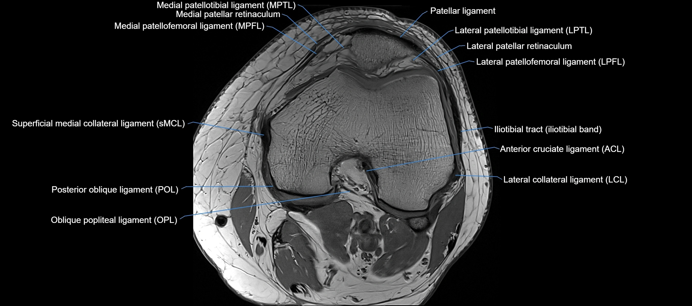 MRI Knee axial  ligaments cross sectional anatomy 3T  radiology  image-img-03001-00020.webp